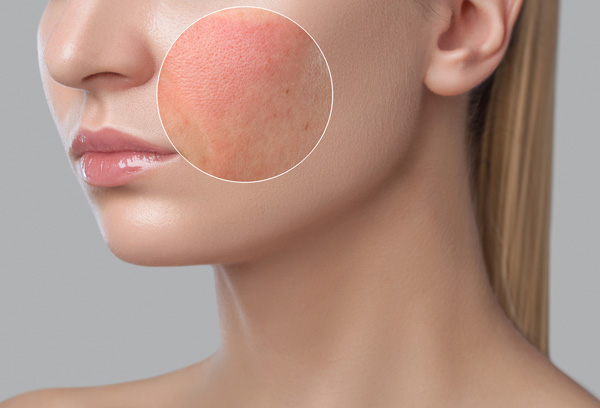 Skin Allergies होने पर अपनाएं ये घरेलू नुस्खे