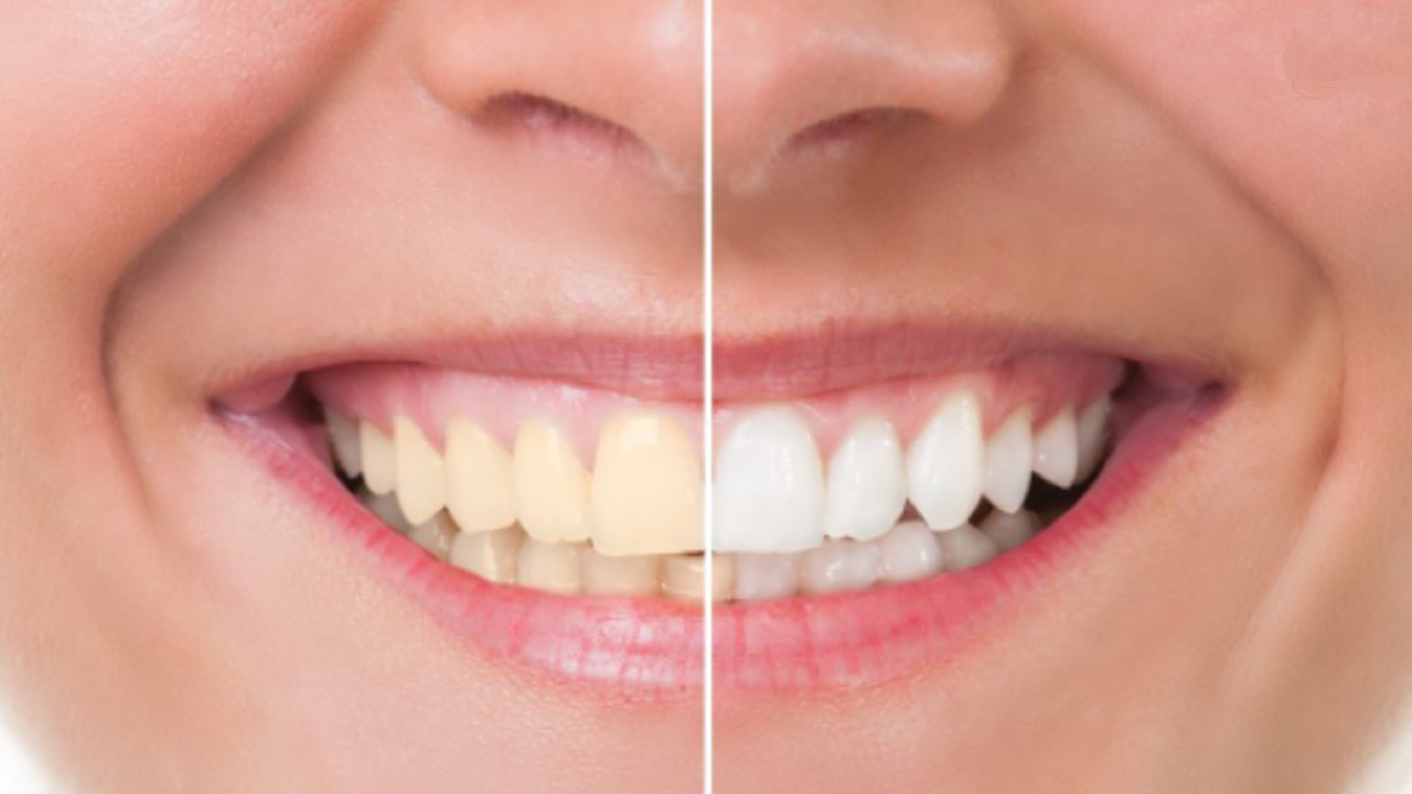 How To Remove Yellowing Of Teeth पीलापन दूर कर दांतों को चुटकियों में चमकदार बनाएंगे ये 5 फल