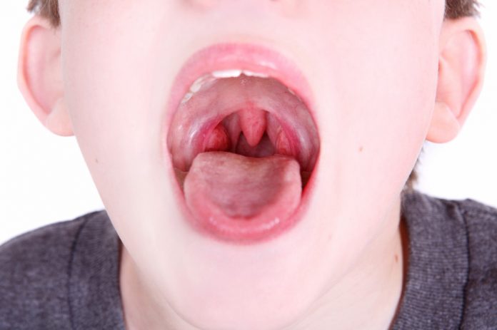 Natural Remedies For Tonsils