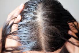 Why Does hair fall After Recovering from Corona Virus