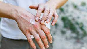  Frequent Hand Washing Harmful