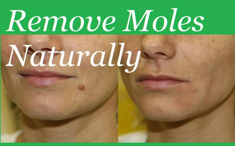 How To Remove Mole: तिल को हटाने के नेचुरल घरेलू उपाय