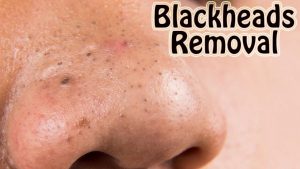 Remove Blackheads From Nose