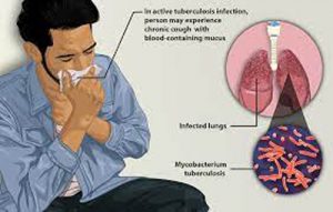 World Tuberculosis Day 2022