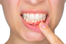 Oral Health Disease