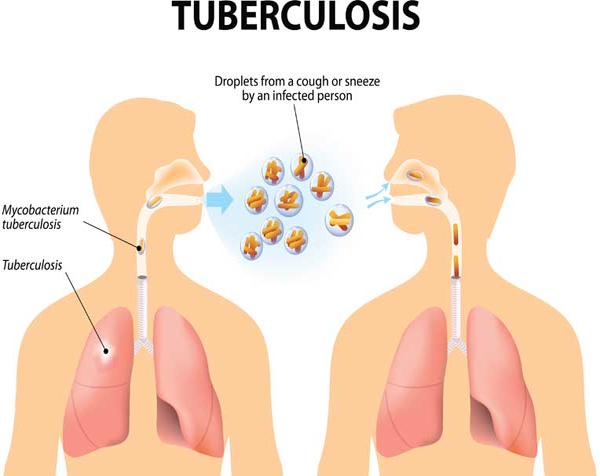 विश्व तपेदिक दिवस : 24 मार्च को हुई थी तपेदिक बैक्टीरिया की पहचान Tuberculosis Bacteria Were Identified On 24 March