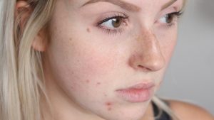 Home Remedies To Remove Red Pimples From Face