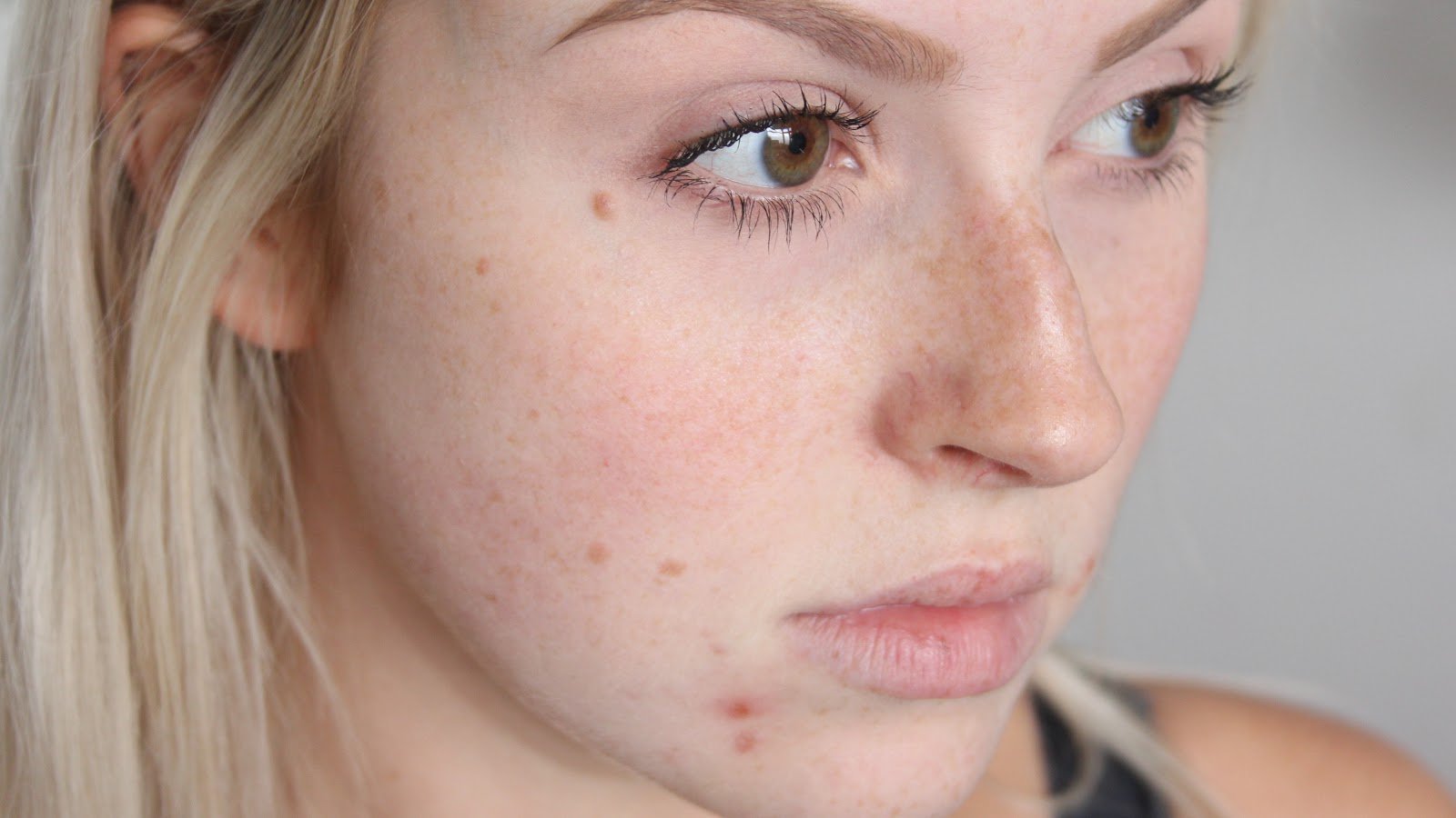 home-remedies-to-remove-red-pimples-from-face