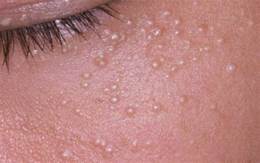 Home Remedies for small Pimples On Face