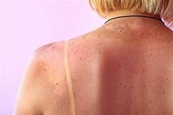 Increased Risk Of Skin Cancer