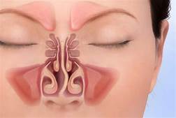 Sinusitis Symptoms And Home Remedies
