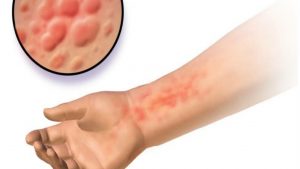Eczema Disease Prevention