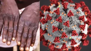 Know which people can be dangerous for monkeypox