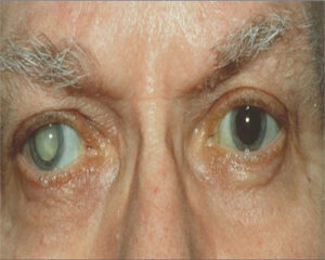 Amla beneficial in cataract