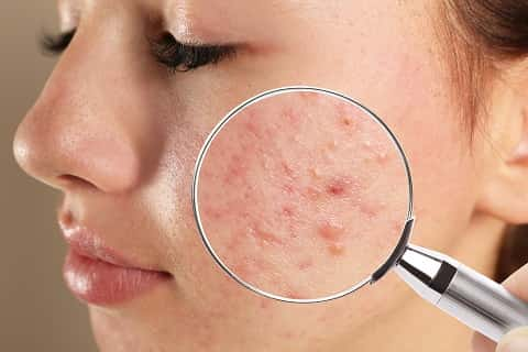 Oily Skin की वजह से होने वाले पिंपल्स से हैं परेशान? इन उपायों को अपनाकर पा सकते हैं निजात