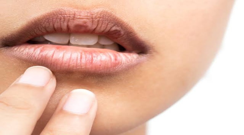 Dry lips: सिर्फ सर्दी से नहीं फटते हैं होंठ, आपकी डाइट भी है जिम्मेदार