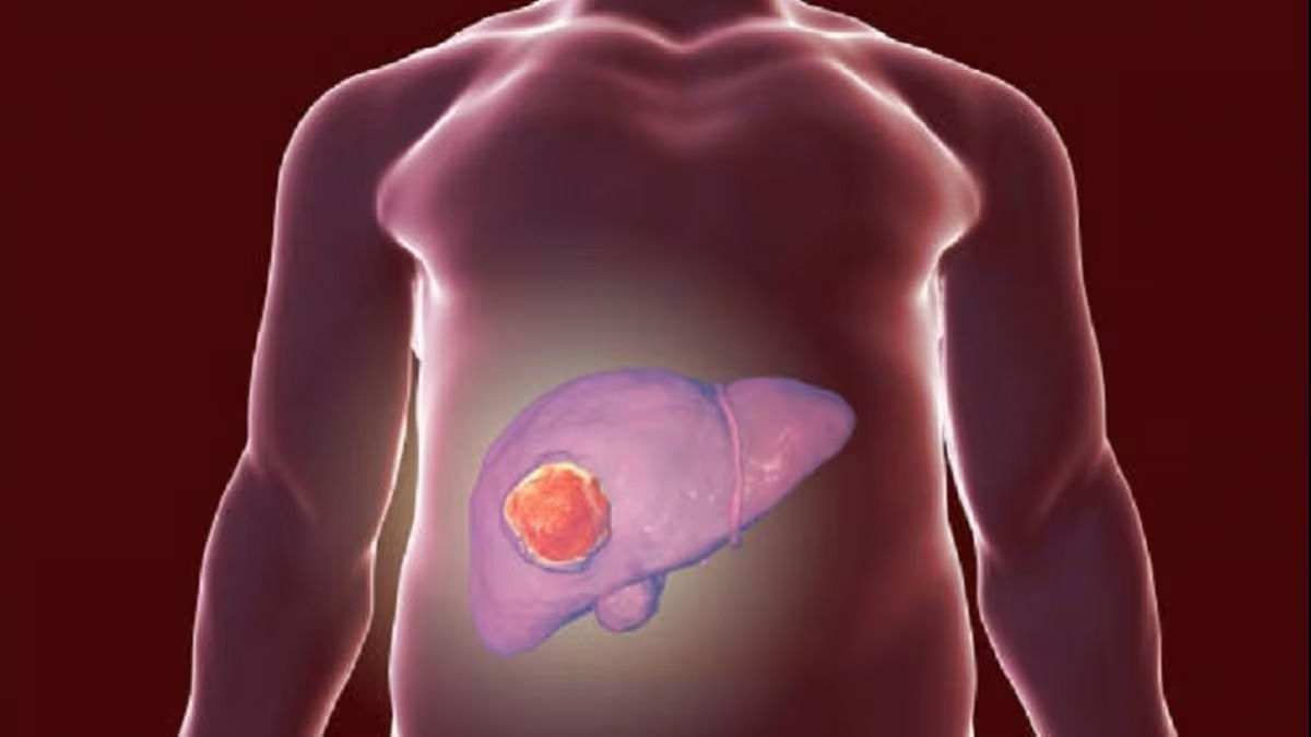 Fatty Liver: गलत डाइट और शराब कर  रही लिवर को फैटी , इससे हो सकता है कैंसर, जानें कैसे बचें