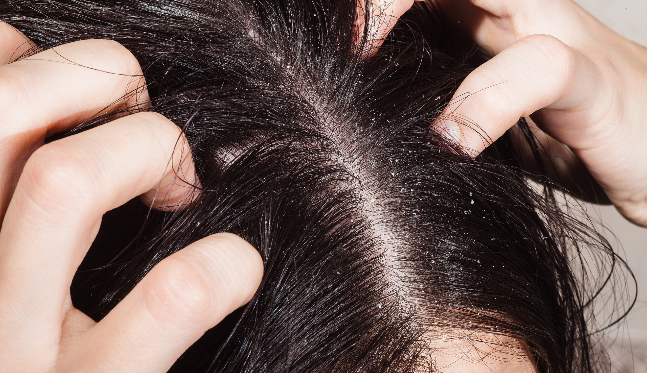 Dry Scalp : बदलते मौसम में स्कैल्प हो रही है रूखी, अपनाएं ये 5 घरेलू उपाय