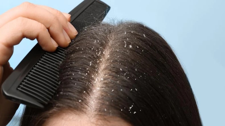 Dandruff Problem: इन तरीकों से रातों रात गायब हो जाएगा डैंड्रफ, करें ये उपाय