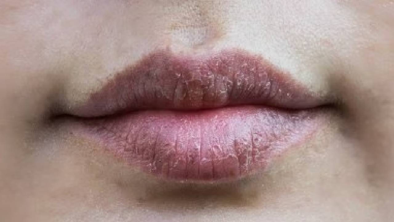 Remove Blackness from Lips: होंठों का रंग पड़ गया है काला तो घरेलू उपाय अपनाएं