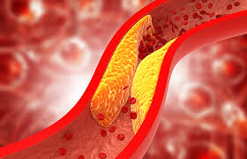 How To Reduce Increasing Cholesterol