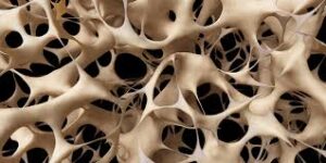 What is Osteoporosis