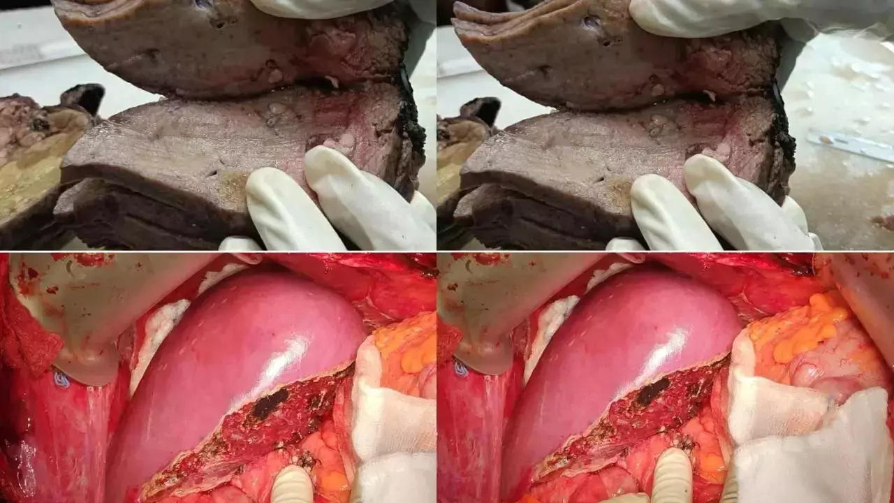कैसा होता है एक हेल्दी लिवर और एक वीकेंड ड्रिंकर के लिवर के बीच का फर्क, डॉक्टर्स की इन तस्वीरों ने कर दिया सबका हाल बेहाल
