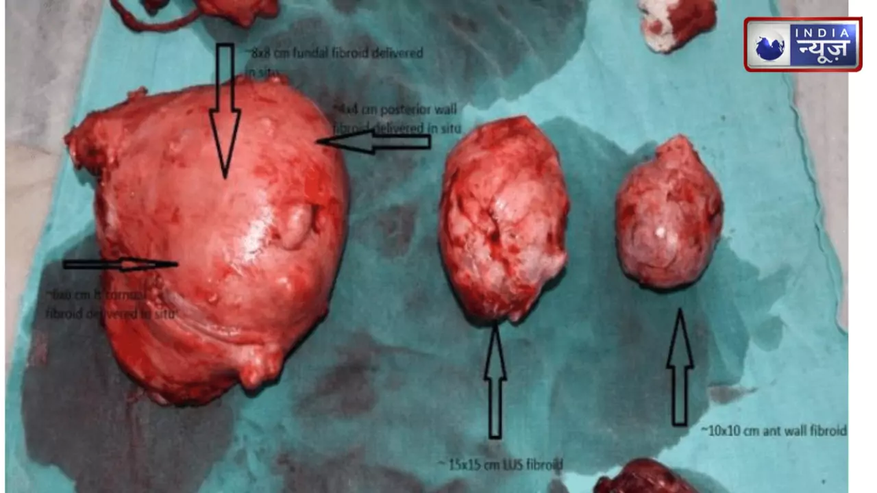 बिना काटा-पीटी के बच्चेदानी की गांठ हो जाएगी मात्र 1 महीने में ठीक, रोज डाइट में एड कर ले ये 5 फल और सिकुड़ने लगेगा फाइब्रॉयड ट्यूमर