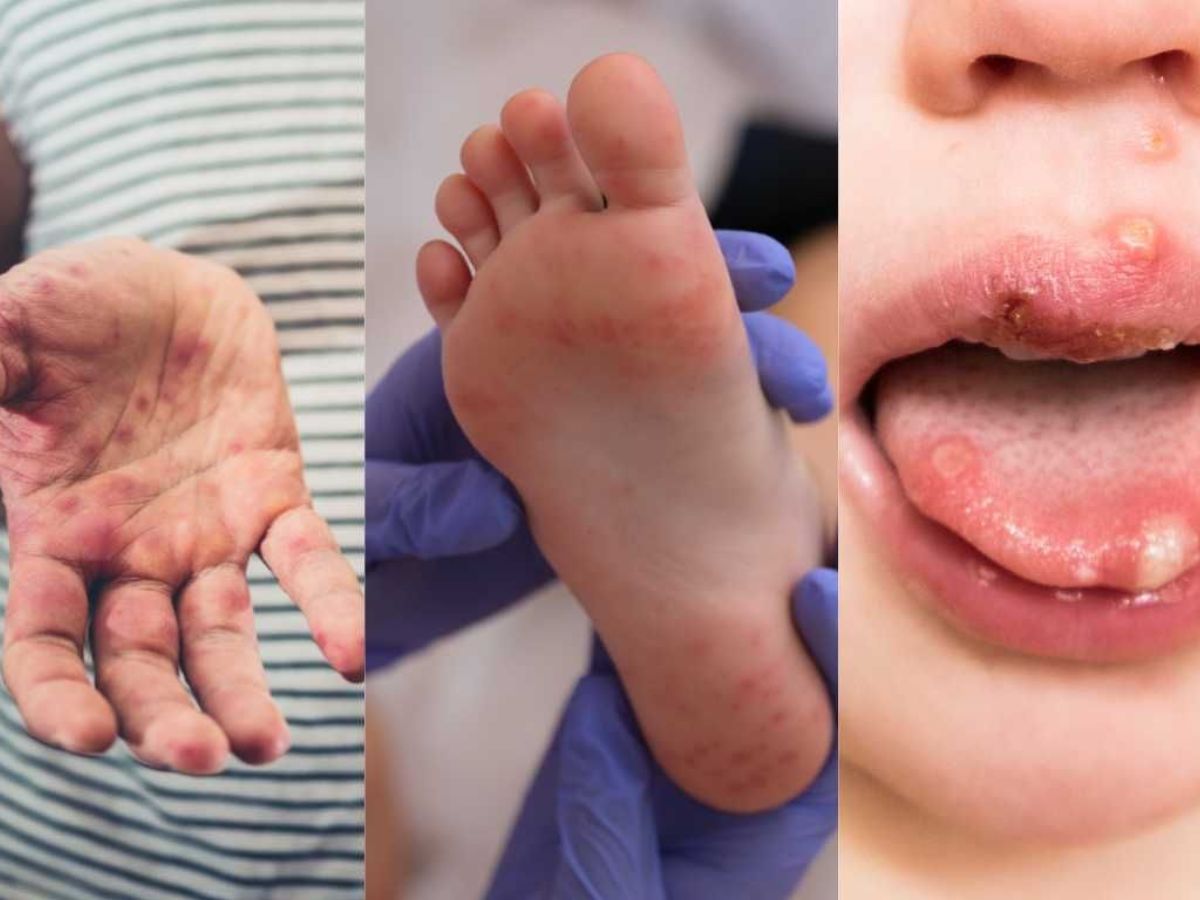 बारिश के बाद फिर बढ़ा खतरा, सिर्फ बच्चे ही नहीं, बड़ो को भी जकड़ रहा है ये हैंड फुट माउथ डिजीज जाने इसके लक्षण और बचाव के उपाय