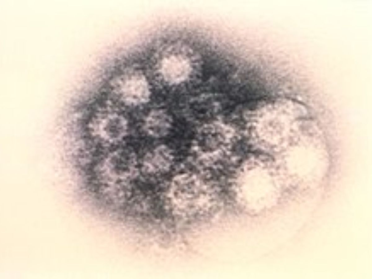 बारिश के बाद फिर बढ़ा खतरा, सिर्फ बच्चे ही नहीं, बड़ो को भी जकड़ रहा है ये हैंड फुट माउथ डिजीज जाने इसके लक्षण और बचाव के उपाय - Gallery Image