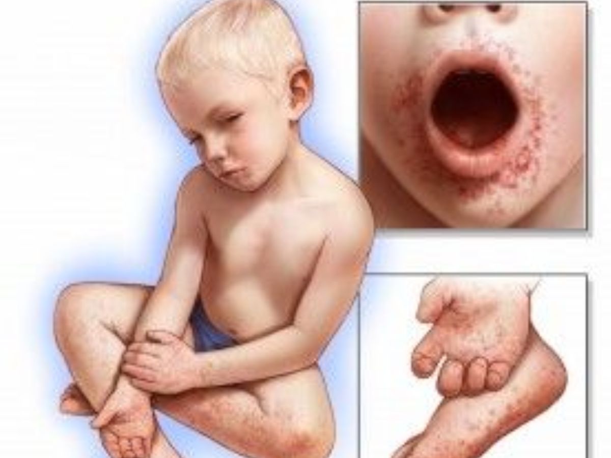 बारिश के बाद फिर बढ़ा खतरा, सिर्फ बच्चे ही नहीं, बड़ो को भी जकड़ रहा है ये हैंड फुट माउथ डिजीज जाने इसके लक्षण और बचाव के उपाय - Gallery Image