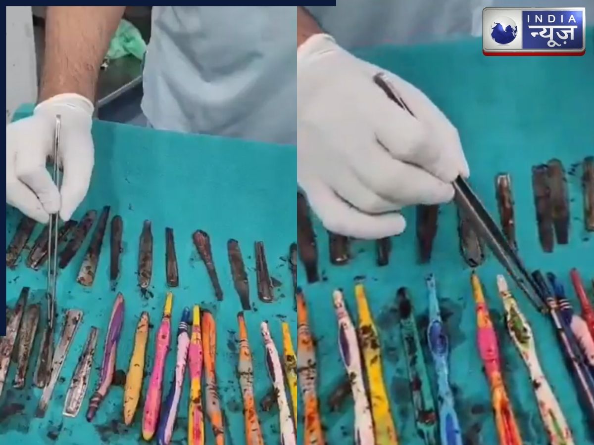 पेट है या स्टोर रूम! शख्स के अंदर से निकले स्टील-प्लास्टिक के 50 Item; फटी रह गईं डॉक्टरों की आंखें