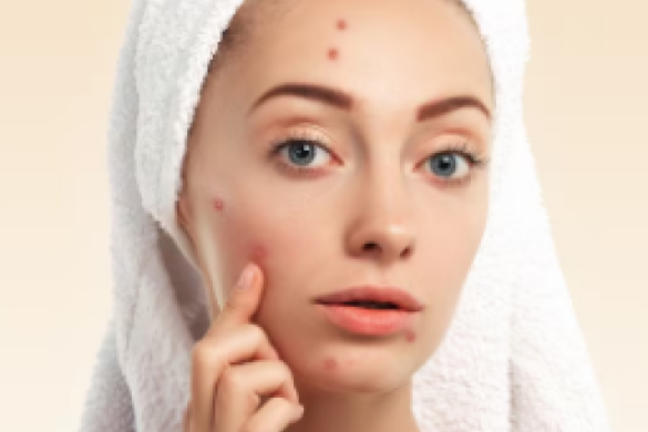 Pimple Causes: चेहरे पर मुंहासो के पीछे छुपा हैं ये राज! जानिए 5 जगहों पर पिंपल होने का क्या है हेल्थ से कनेक्शन