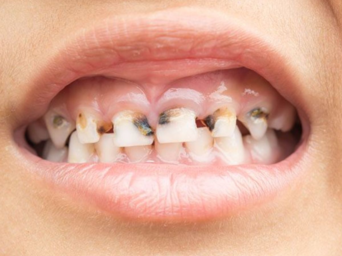 ब्रश के तुरंत बाद चाय कर सकती है आपके दांतो की उम्र कम, जानें क्यों है हानिकारक? - Gallery Image