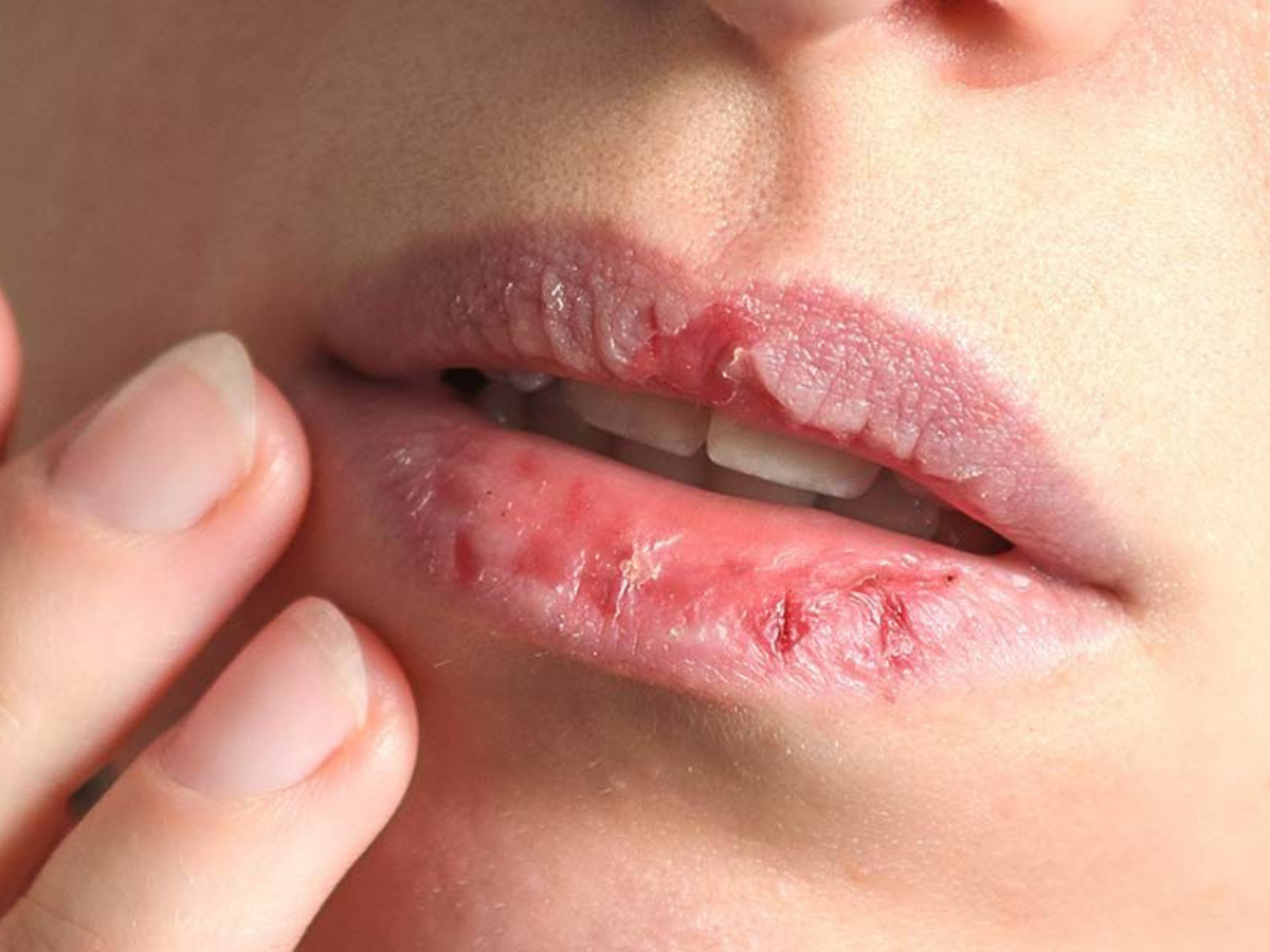 Lips Tend To Crack In Winter - Photo Gallery