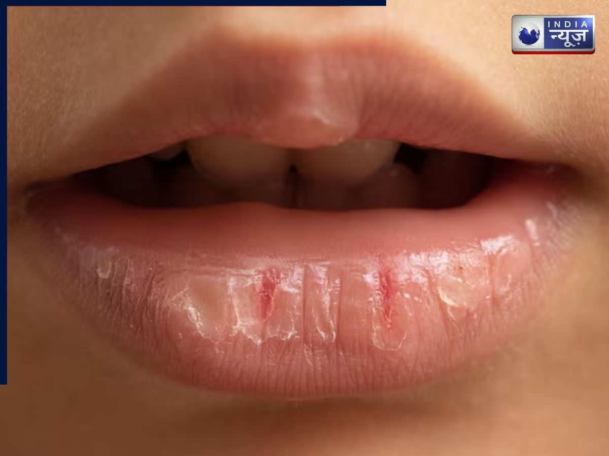 Dry lips - Photo Gallery