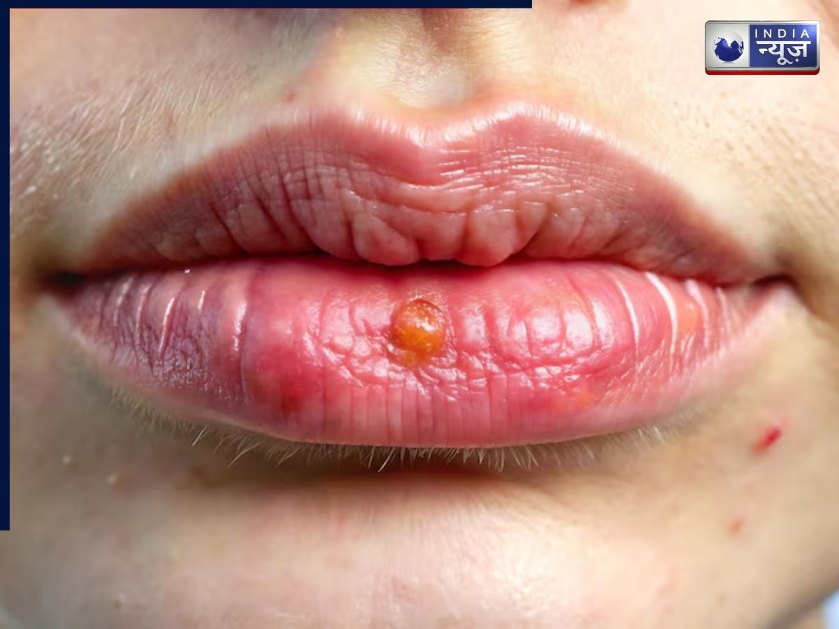 Blisters or sores on the lips - Photo Gallery