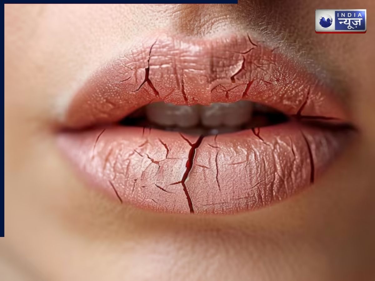 Cracks on the lips or corners of the mouth - Photo Gallery