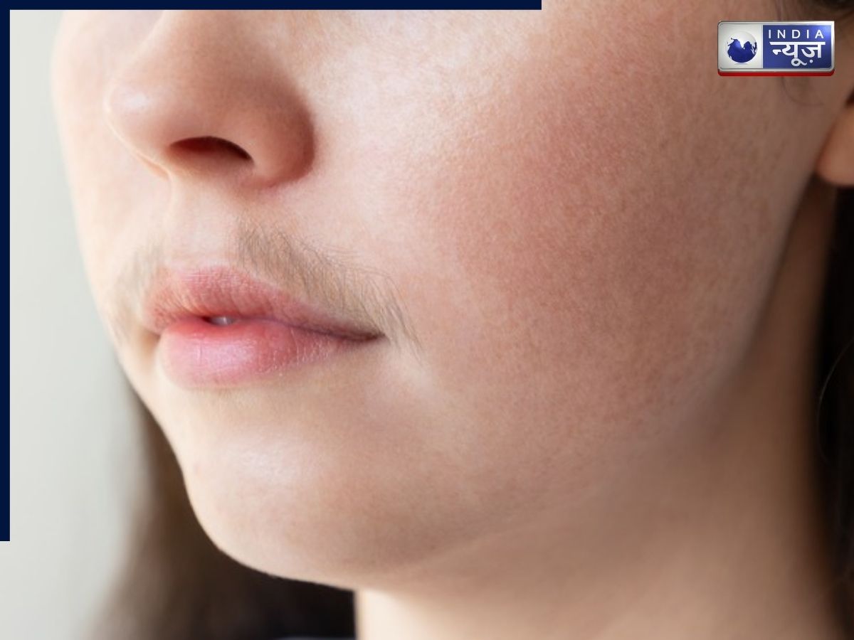 Hirsutism Causes in Women - Photo Gallery