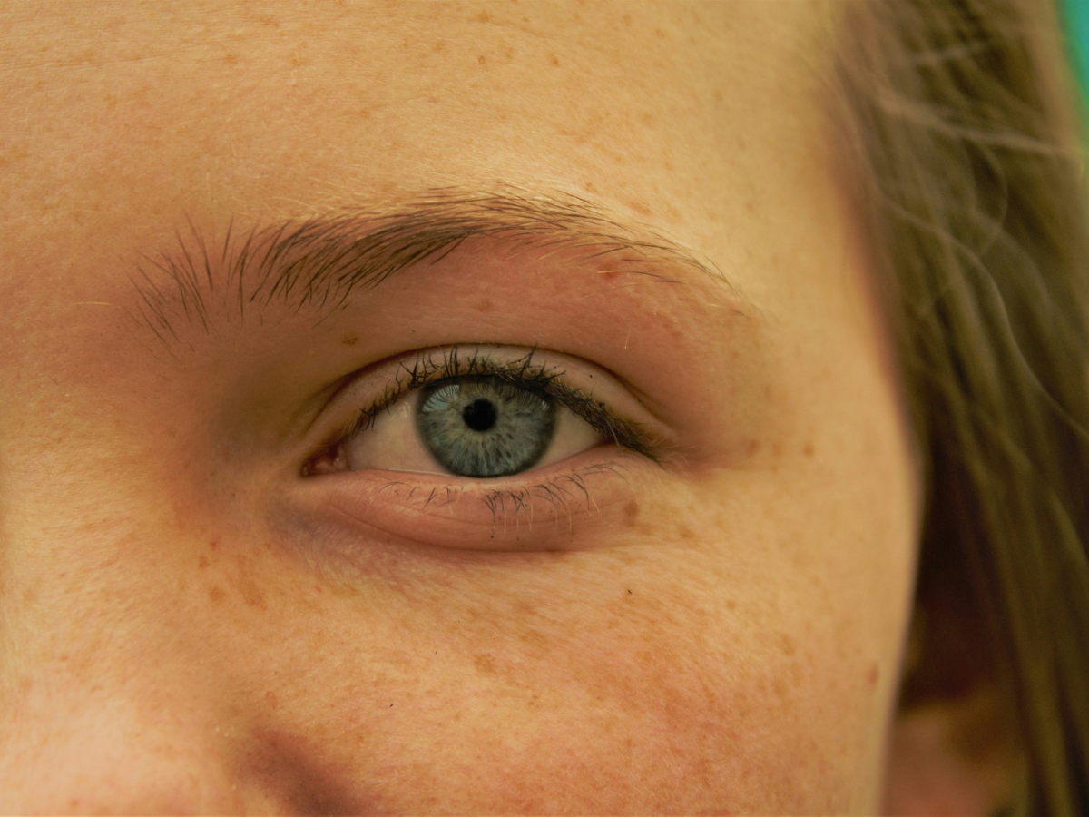 Protects Against Hyperpigmentation - Photo Gallery