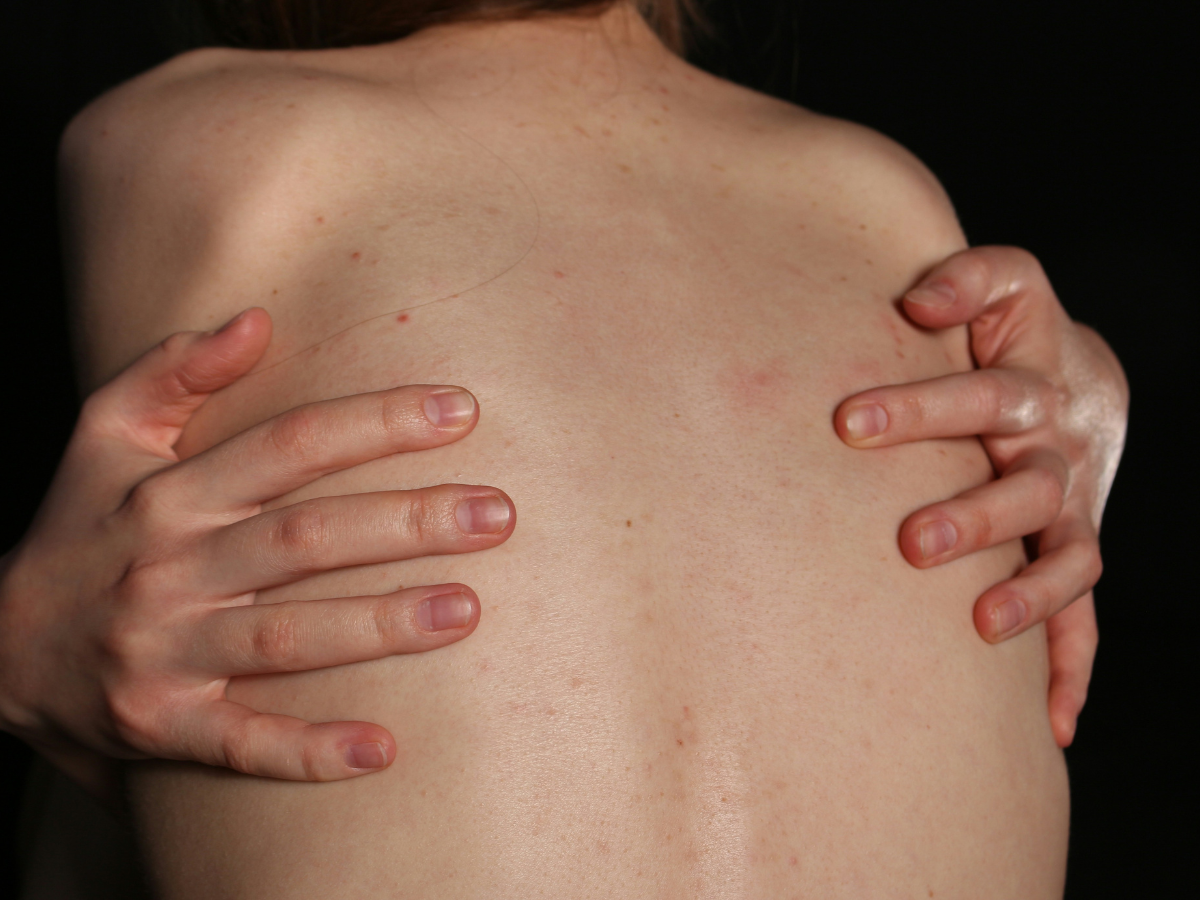 UV Rays Damage Skin - Photo Gallery