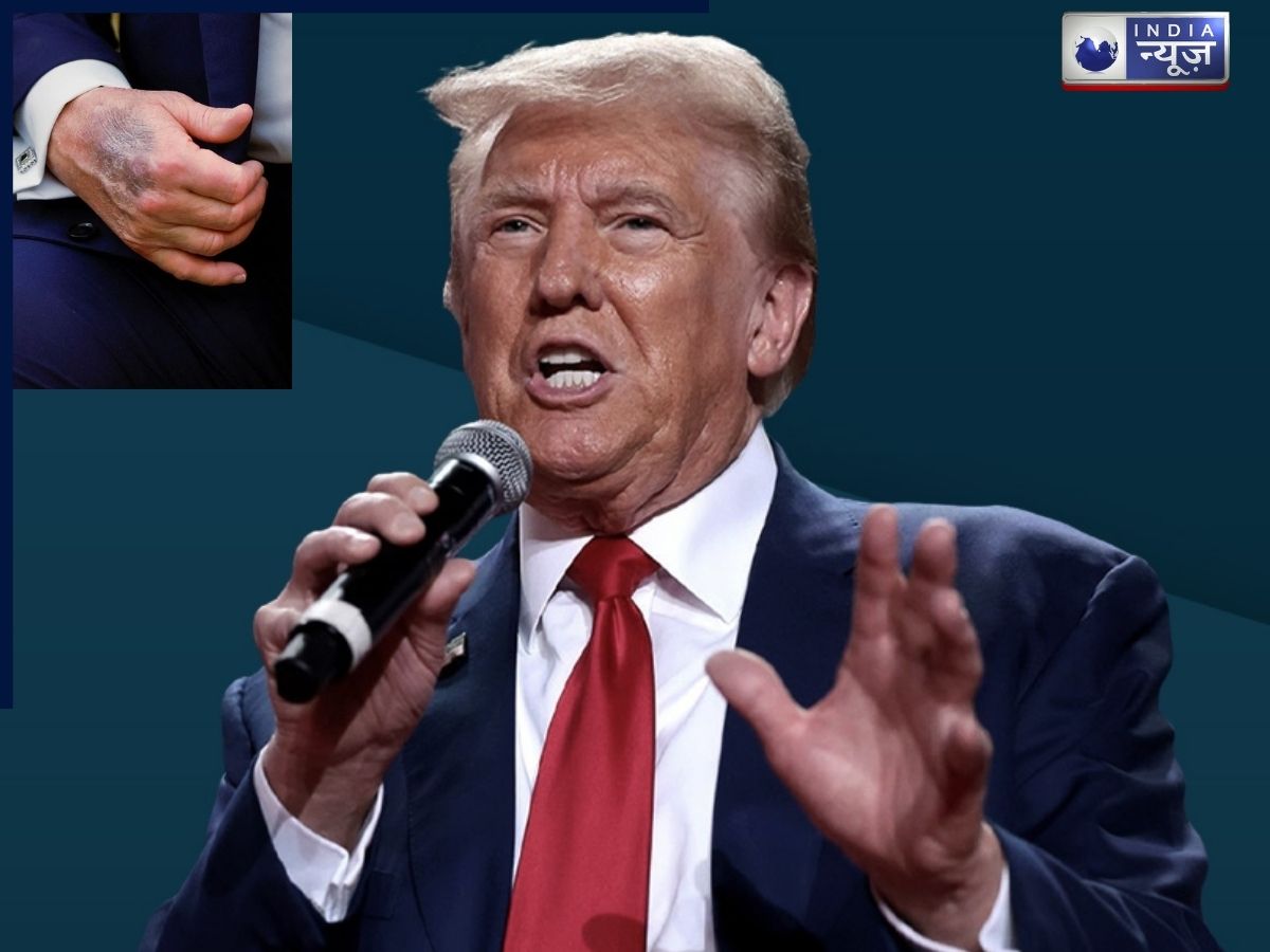 ‘मैं बहुत ज्यादा एस्पिरिन लेता हूं…’ ट्रंप के हाथों पर नीले निशान ने मचाई खलबली, क्या छुपा रहे हैं अमेरिकी राष्ट्रपति?