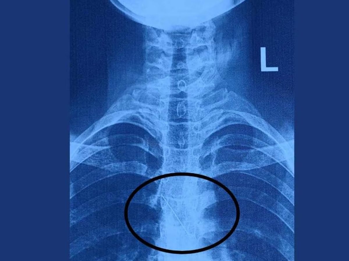 मुंह में पिन क्यों नहीं रखनी चाहिए? वडोदरा की किशोरी से हो गई गलती, डॉक्टर ने 4 घंटे की मशक्कत के बाद निकाली