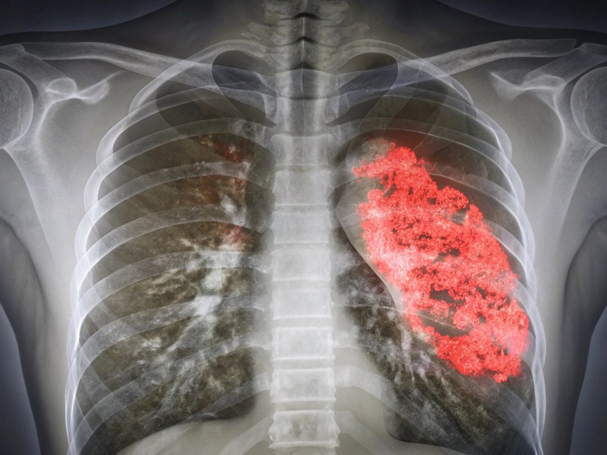 जहरीले पॉल्यूशन का फेफड़ों पर हमला, शरीर बन रहा बीमारियों का घर, लंग्स बचाने के लिए खाना शुरू कर दें ये चीजें - Gallery Image