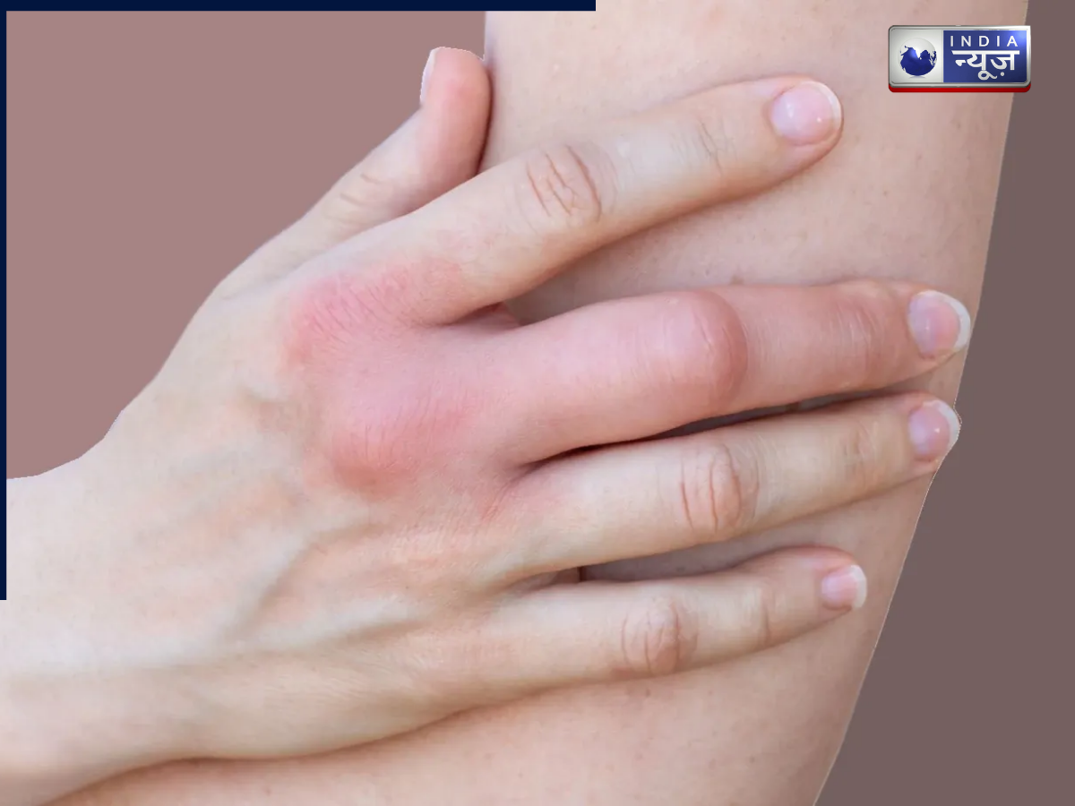 सर्दियों में उंगलियों की सूजन से परेशान! अपनाएं डॉक्टर्स की ये 5 आसान टिप्स, झटपट मिलेगा छुटकारा