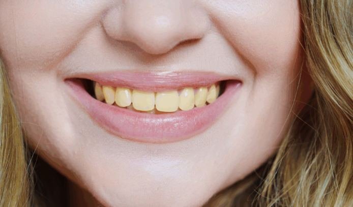 Curcumin makes teeth yellow - Photo Gallery