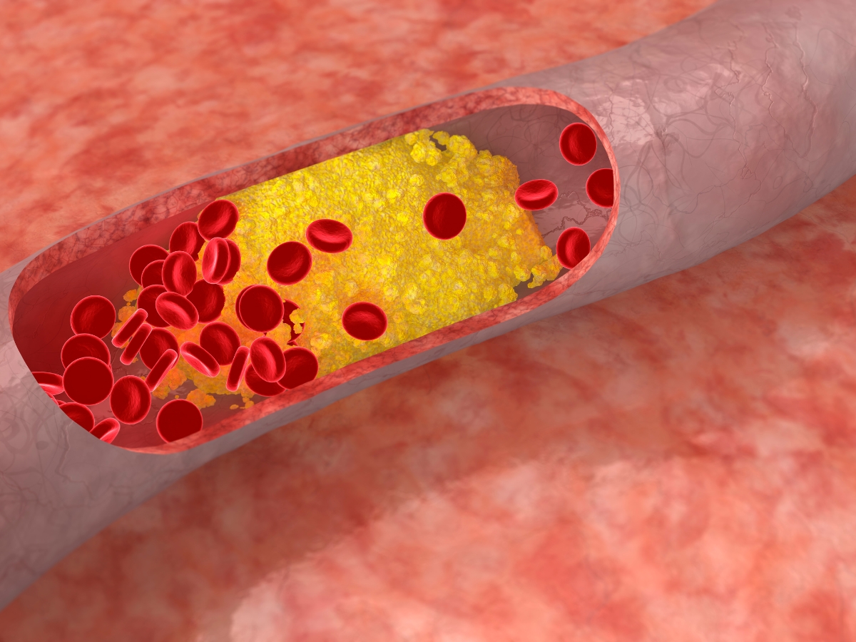 High Cholesterol - Photo Gallery