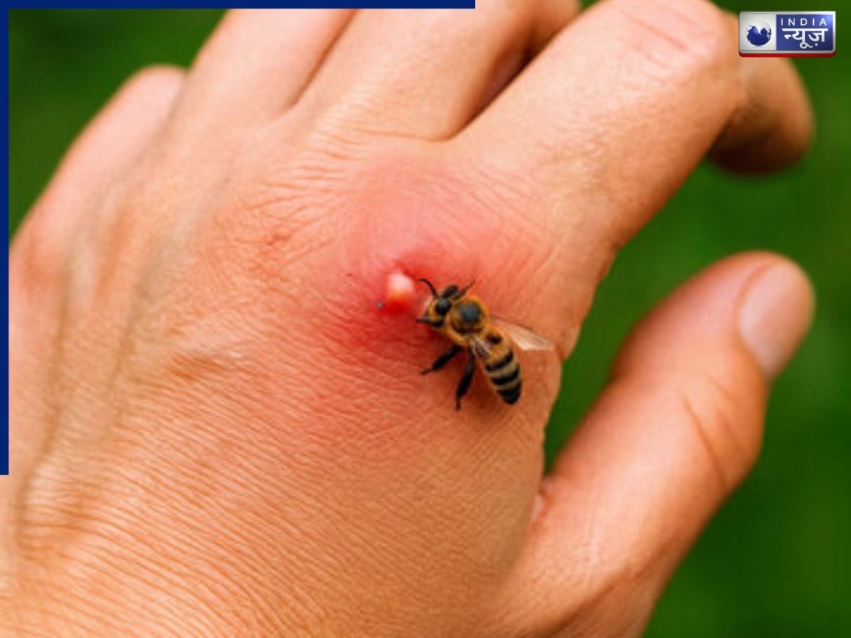 bee sting treatment at home - Photo Gallery