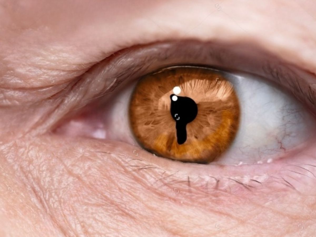 congenital disease Coloboma in child - Photo Gallery