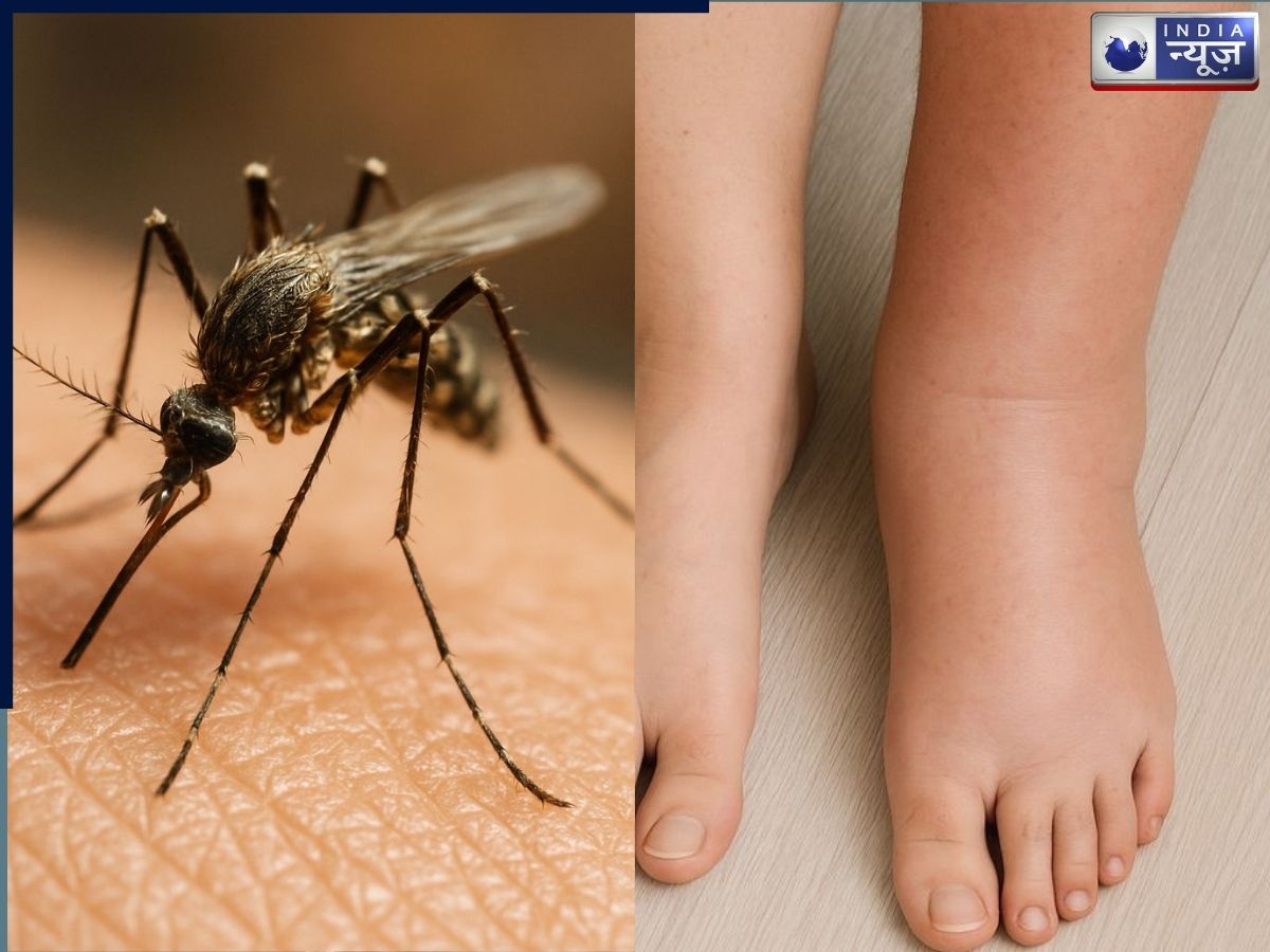 मच्छर के एक काटने से बन सकता है पैर हाथी जैसा! जानें क्या है हाथी पांव बीमारी, क्यों तेजी से फैल रही है और कितना है खतरा